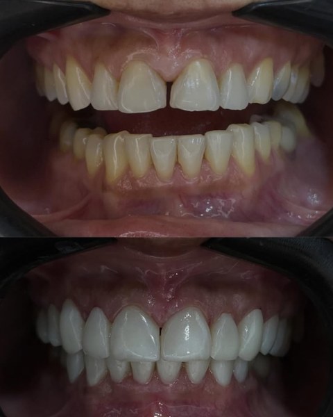 Antes e depois de lentes de resina — Um sorriso de dar inveja