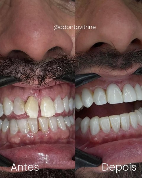 Antes e depois de lentes de resina — Adeus, dentes tortos e espaçados