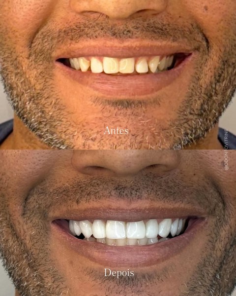 Antes e depois de lentes de resina — A transformação que você sempre quis, em poucas sessões